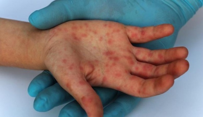 Oι ειδικοί απαντούν: Δεν υπάρχει επιδημία ιλαράς στην Ελλάδα