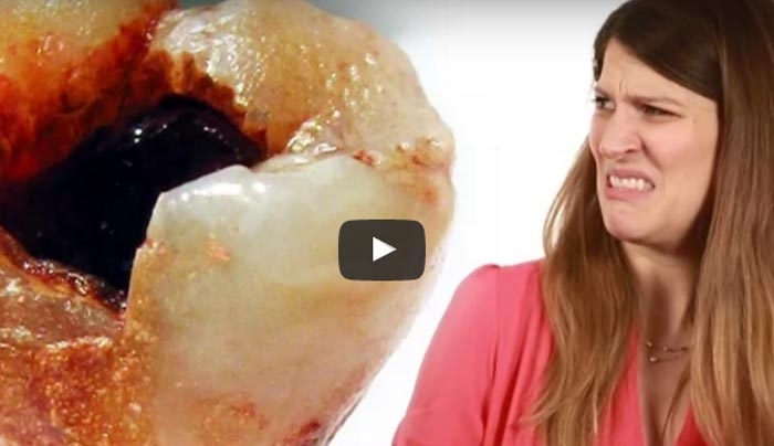 Πώς σχηματίζονται οι τρύπες στα δόντια (βίντεο)