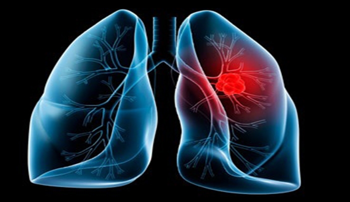 Ο καρκίνος των πνευμόνων Νο1 αιτία θανάτου των γυναικών στην Ευρώπη