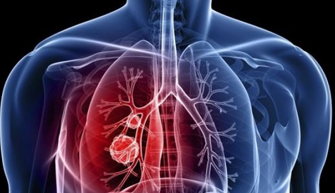 Ο καρκίνος του πνεύμονα «κρύβεται» για χρόνια