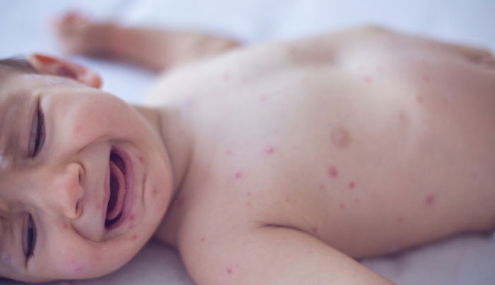 Θερίζει όλη την Ευρώπη η ιλαρά: Άυξηση 400% στα κρούσματα – Κραυγή των ειδικών για εμβολιασμό