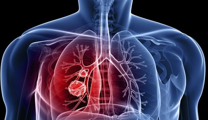 Εγκρίθηκε νέο φάρμακο για τον καρκίνο του πνεύμονα