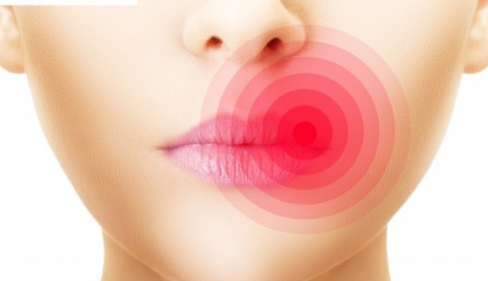 Έρπης στο στόμα: Αίτια και πρώιμα συμπτώματα